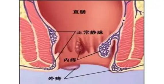 痔疮吃什么好  第2张