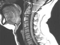 脊髓空洞症做完手术多久恢复原状 