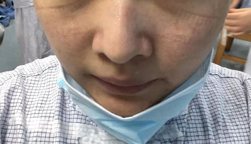 新冠肺炎 如何防治戴口罩带来的皮肤损伤 北京协和医院皮肤科专家支招