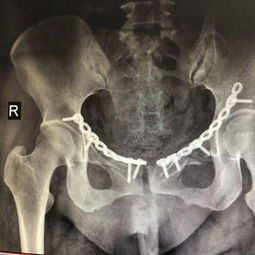 左侧耻骨下支骨折图片 图片搜索