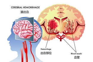 因为脑出血做的造影，做完后总头疼，是咋回事儿