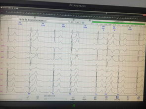 holter所见心律失常 心血管内科讨论版 爱爱医医学论坛 