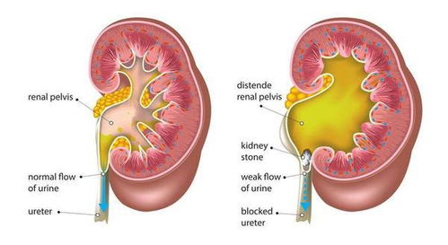 肾结石治疗后为什么还会反复发作 劝告 尽量改掉这个习惯