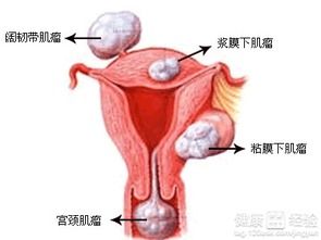 局限性子宫腺肌症如何治疗