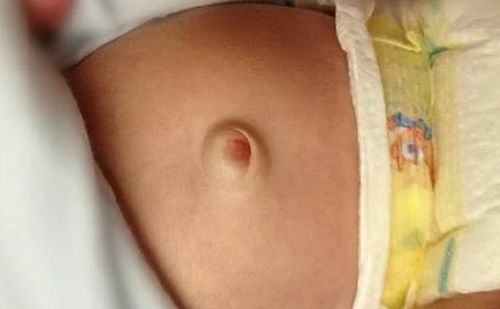 胎儿脐疝是什么原因(胎儿脐疝可以自愈吗)
