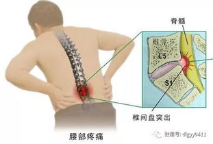 为什么腰椎间盘突出在腰，却痛在腿(腰椎间盘突出为何会导致腰腿痛?)