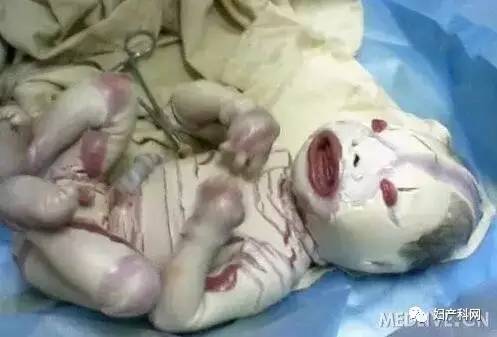 火棉胶婴照片(河南婴儿刚出生就被诊断为火棉胶)