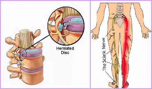 明明我只是腿疼,为什么医生却说我腰椎间盘突出呢