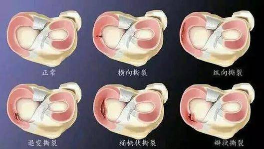 半月板后角撕裂的最好治疗方法