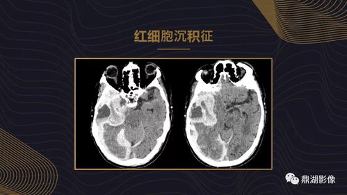 不简单 脑出血超详细学习笔记