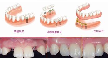 种植牙的利弊(活动牙和种植牙的利弊)