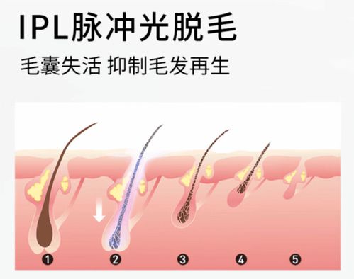 家用脱毛仪会让皮肤变黑