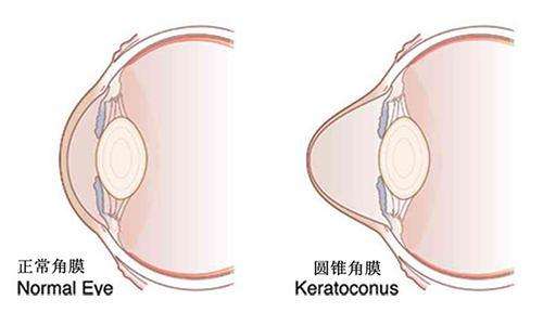 近视术前检查出的圆锥角膜你了解多少