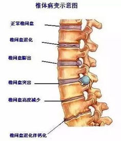 腰间盘膨出有什么最有效的简单锻炼方式(腰间盘膨出怎么锻炼效果最好最快)