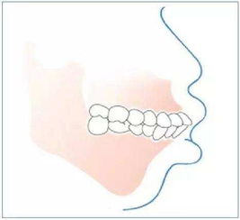 牙齿不齐的6种形式,为什么你的牙齿会长歪