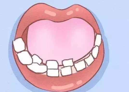 双排牙怎么办,双排牙是什么原因造成的