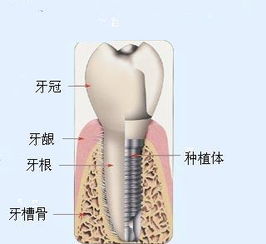 哪家牙科医院镶牙不疼 