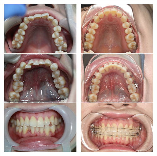 杭州牙齿矫正到满意的状态可以提前停止矫正吗