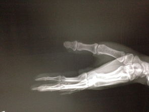 我是工伤的.左拇指缺损伤,指甲全部脱落,请问左拇指那里骨折 做伤残鉴定应该属几级 .衷心感谢 