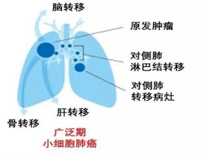 放疗,消灭各阶段肺癌都 大有可为 下