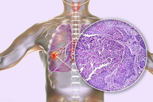 肺腺癌大多数是女性吗 恶性程度更高还是更低 一文讲清