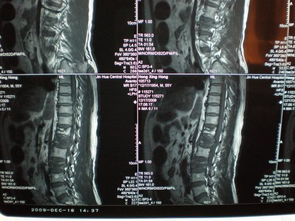 腰椎横突l2l3骨折图片 搜狗图片搜索