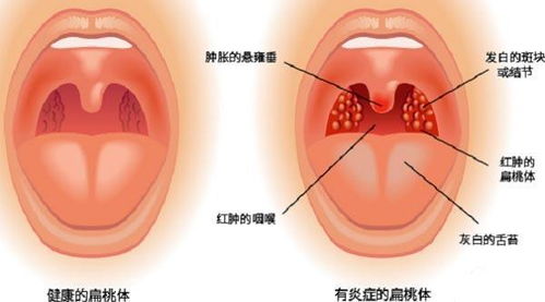 咽炎 扁桃体炎反复发作总不好 金堤古方老中医这个方子,用一个好一个