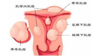 女性卵巢囊肿的症状有哪些