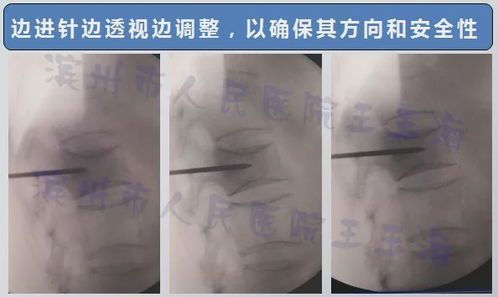 骨头里打水泥,听说过没 来看看这个技术起什么作用