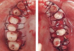 牙位异常时的牙周外科处理 接触点异常 一