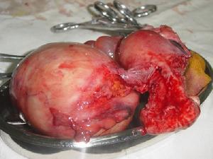 卵巢畸胎瘤 