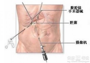 腹腔镜手术后何时会来月经