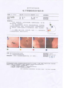 近一段时间周围同事都在议论,幽门螺旋杆菌传播厉害,我就去医院做了检查,大夫建议做个胃镜,于是又做了 