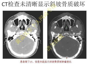 鼻咽癌患者为什么要做磁共振或者PET CT