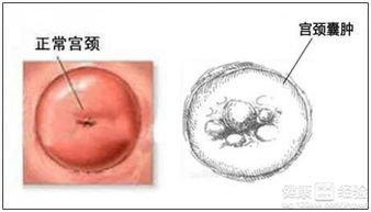 宫颈囊肿的临床表现教你如何辨别宫颈囊肿