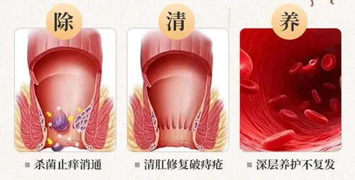 痔疮自愈的小偏方,不打针 不吃药,坚持1个月好处看得见