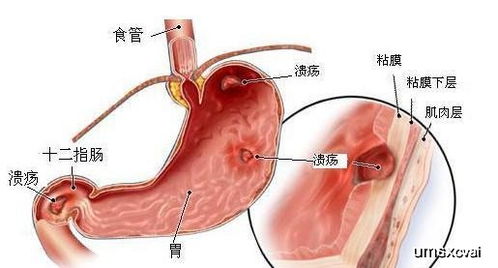 胃炎会变成胃癌吗 内科主任 这4个征兆是胃癌早期