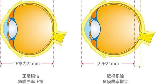 近视防控 选对镜片很重要 鸿晨青少年离焦防控镜片