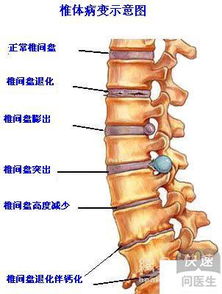 腰椎间盘突出症手术好吗