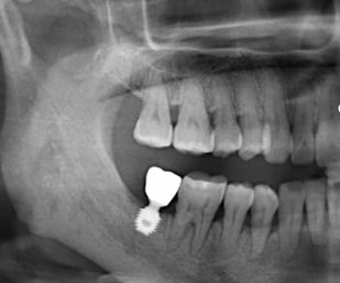 严重的牙周炎,牙槽骨条件差还能种植牙吗 成功率高吗