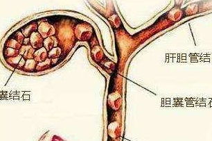 胆囊切除术后的副作用有哪些