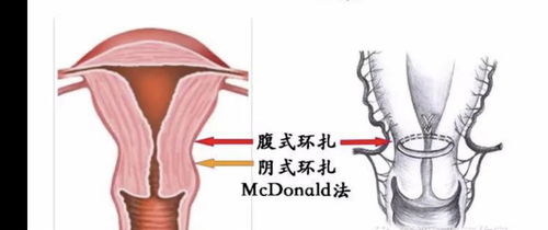 腹腔镜下宫颈环扎术 让保胎不再难