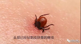 如何取出叮咬在皮肤上的致命蜱虫 视频版