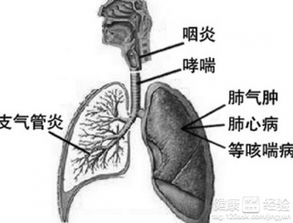 肺炎和支气管肺炎的区别