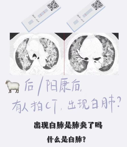 肺发白是新冠肺炎吗（肺发白是咋回事） 第1张