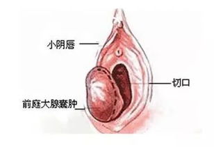 前庭大腺图片位置 搜狗图片搜索