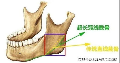 韦敏教授经验分享丨下颌角截骨怎么截看起来更自然