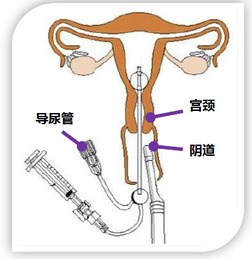 输卵管造影术 子宫输卵管造影术简介