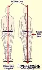 长短腿矫正方法之二 成年后长短腿怎么矫正