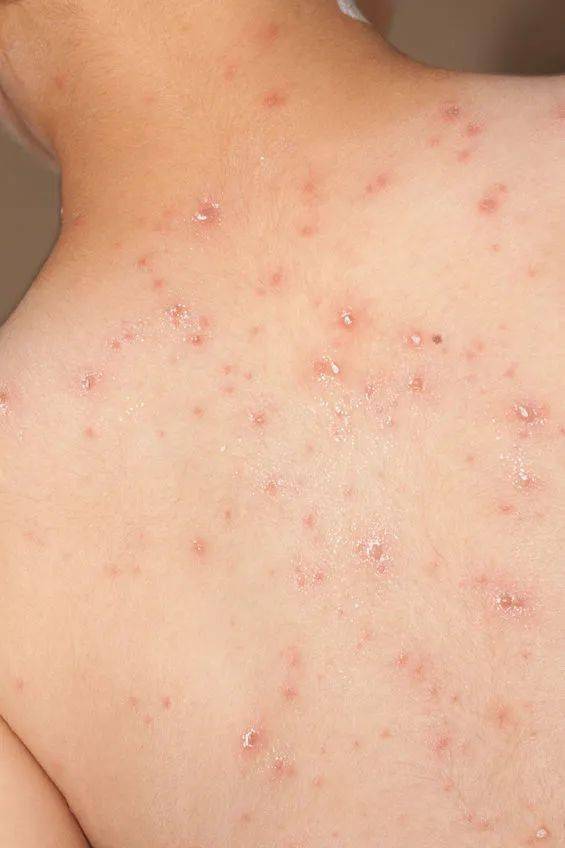 水痘传染性强,大人孩子都可发病 起水痘怕感染,到底能不能洗澡